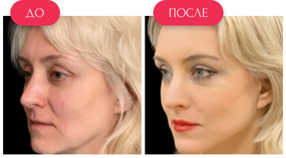  — до и после