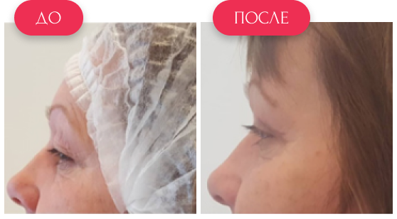  — до и после