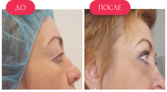  — до и после